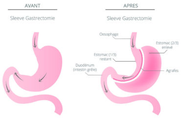 La Sleeve Gastrectomie Calculersonimc